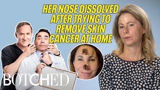 Kelly Tried To Remove Her Own Skin Cancer At Home?! | Botched | E!