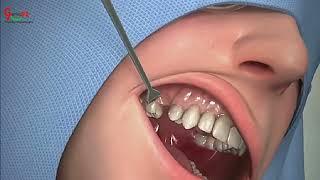 Teeth Planting Surgery #Teeth #Surgery #gamer #gaming92