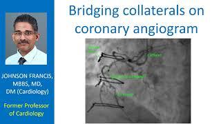 Bridging collaterals on coronary angiogram