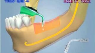 Flapless Alveolar Crest Splitting Surgical Protocol (Knochenaufbau Kieferkamm - Verbreiterung)