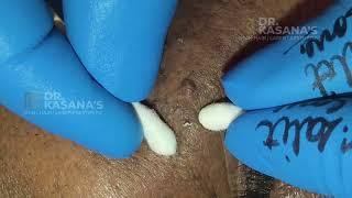 I Removed BLACKHEADS for 4 minutes  Here's What Happened - New Blackheads