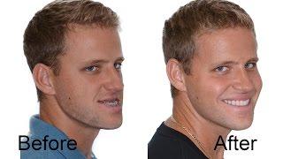 Jaw Surgery / patients speaks about his experiance