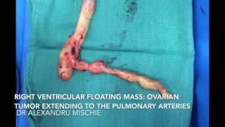 Right ventricular mass: a ovarian tumor extending to the pulmonary artery. Dr. Alexandru Mischie