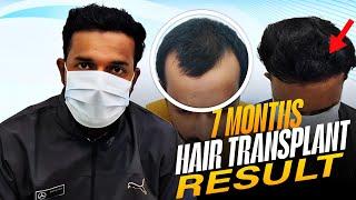 Hair transplant in indore | 7 Months Result Hair Transplant Journey