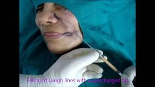 Best Fat injections face delhi, best wrinkle correction delhi, best smile line correction delhi