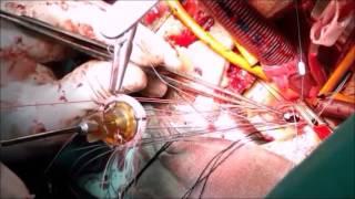 Aortic Valve replacement through mini sternotomy
