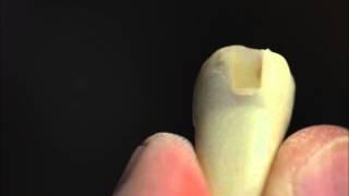 My Favorite Posterior Composite Resin and Curing Light