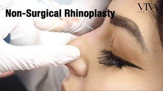 Non-Surgical Rhinoplasty | VIVA Skin Clinics