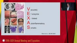 5-Inflammaging, comorbidities and VEXAS syndrome in MDS pathogenesis