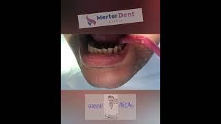 Tooth Stone Cleaning - Dr. Serhan Aktan