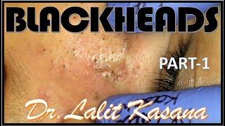 BLACKHEAD REMOVAL PART 1 BY DR.LALIT KASANA