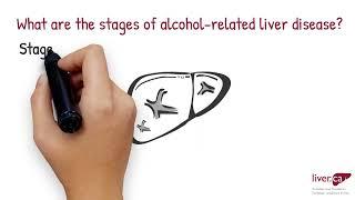 The Stages of Alcohol-Related Liver Disease