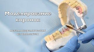 Моделирование металлокерамических коронок  ivoclar,  имплантация зубов  влог