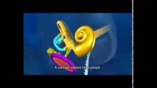 Cochlear implants - how do they work?