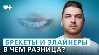 Брекеты и элайнеры. Что выбрать для исправления прикуса?