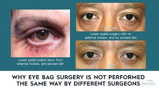 Why Eye Bag Surgery/ Lower Blepharoplasty is Not Performed the Same Way by Different Surgeons