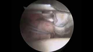 Arthroscopic Labral Reconstruction of the Hip by Dr. Andrew Wolff (Washington, DC)