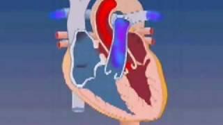 Atrial Septal Defect