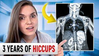 NONSTOP HICCUPS! An Endless Nightmare: Is There a CURE?!