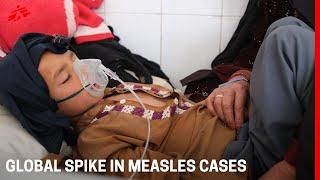 Why is the number of kids with measles spiking? MSF epidemiologist explains #vaccination #measles