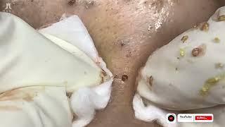 Big Cystic Acne Blackheads Extraction Blackheads & Milia, Whiteheads Removal Pimple Popping