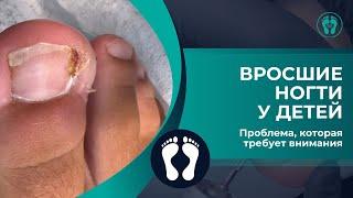 Вросшие ногти у детей! Проблема, которая требует внимания...