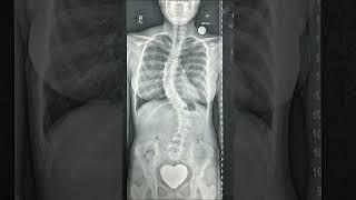 Understanding Scoliosis: A Guide to Spine Health #scoliosis #backpain
