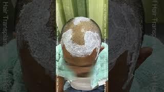 FUE Hair Transplant Journey | SM Hair Transplant Clinic | Panipat | Shamli