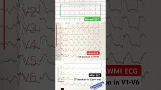 Ecg of different Heart attack l #ecg #echo #shorts
