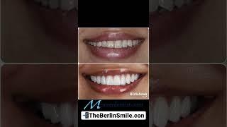 Bigger. Brighter. Whiter. The Berlin Smile  #shorts #dentist #cosmetic #dallas #texas #veneer