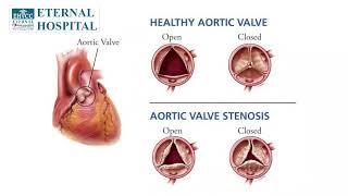 Eternal Hospital | TAVI | Dr. Prashant Diwedi
