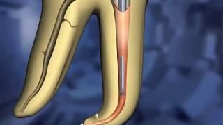 Техника пломбирования каналов жидкой гуттаперчей