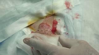 Busy Bee Cyst Removal - Dr. John Gilmore