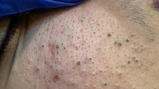 My Secret to Blackhead-Free Skin Revealed