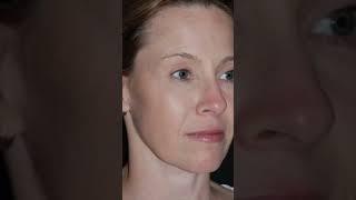 AMAZING Facial Rejuvenation RESULTS Revealed by OculoFacial Surgeon