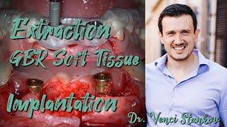 Extraction teeth. GBR Soft Tissue. Dental implantation. Dr. Venci Stankov