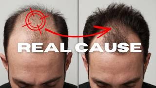 Male Pattern Baldness - REAL Underlying Cause Explained (Galea Aponeurotica)!