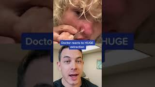 GIANT Pimple Extraction on Nose | 208SkinDoc