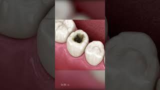 Composite Dental Fillings: ASMR