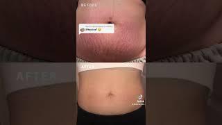 Results from using Silicone Body Patches for stretch marks 