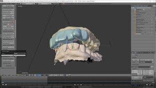 D3Splint - Anterior Deprogrammer Design