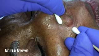 Filament and Blackhead Extractions