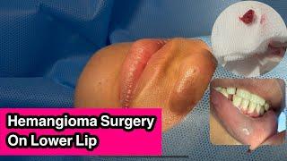 Hemangioma Excision On Lower Lip