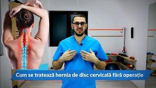 Cum poți trata hernia de disc cervicală fără operație kinetoterapie cervicală