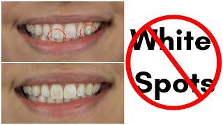 !NEW PROCEDURE! How to Reverse White Spots Lesions on Teeth