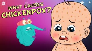 What Causes Chickenpox? | The Dr. Binocs Show | Best Learning Videos For Kids | Peekaboo Kidz