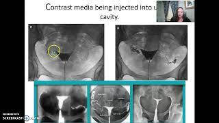 Hysterosalpingogram (HSG)