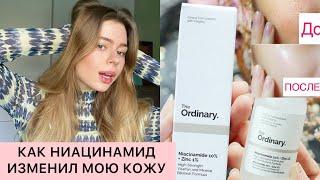 НИАЦИНАМИД | КАК МОЮ КОЖУ ИЗМЕНИЛ THE ORDINARY NIACINAMIDE , как правильно использовать , постакне