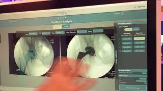 Digital Surgery Solutions: JointPoint Software Platform for Hip Surgery