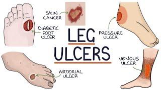 Understanding Leg and Foot Ulcers